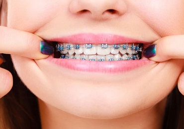 Keep teeth clean with braces