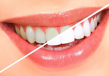 Teeth Whitening / Bleaching Dental Services