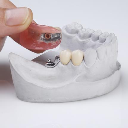 precision dentures cost in bangalore 