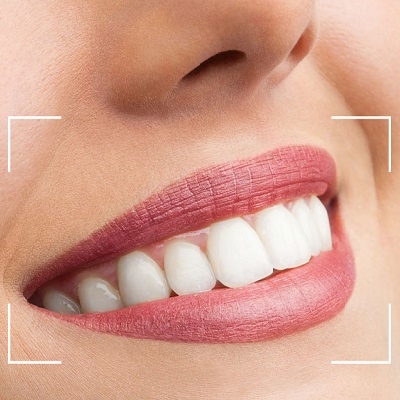 Cosmetic Dentistry in Bangalore