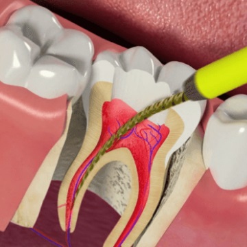 root canal treatment cost in bangalore